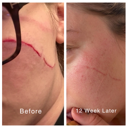 Smooth Your Scars In Just 60 Seconds