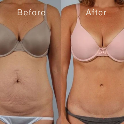 Smooth Your Scars In Just 60 Seconds